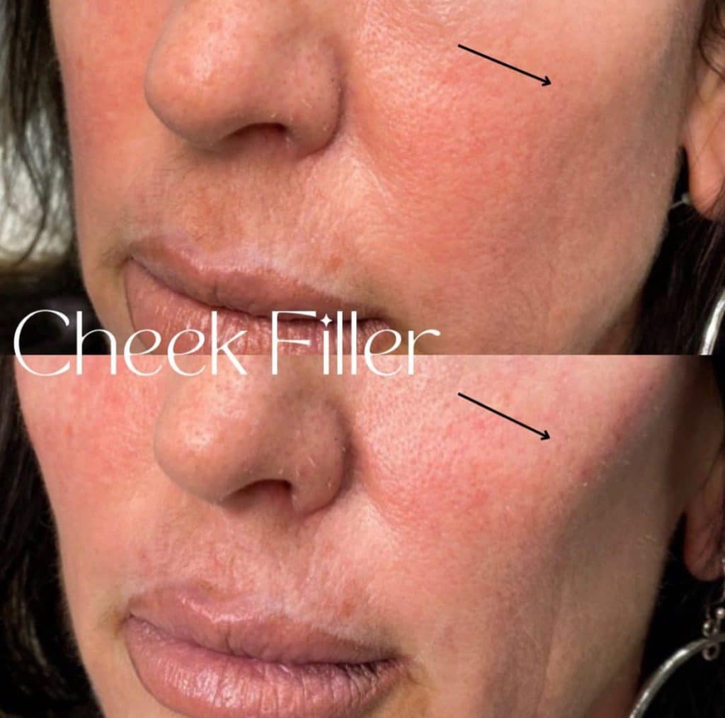 cheek filler before and after 1024x1013