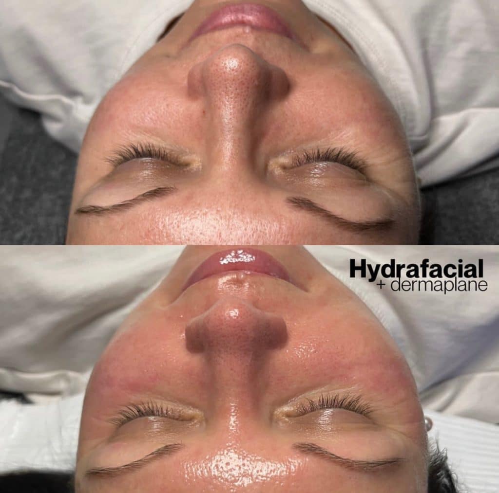 hydrafacial before and after 1024x1013
