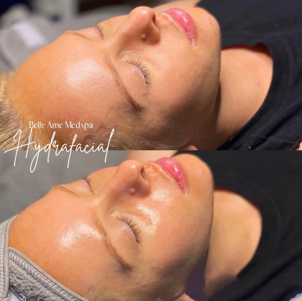 hydrafacial before and after1 1024x1020