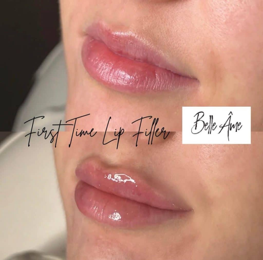 lip filler before and after 1024x1011