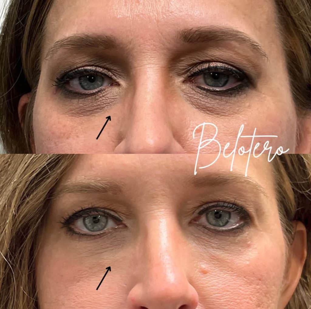 undereye filler before and after 1024x1018